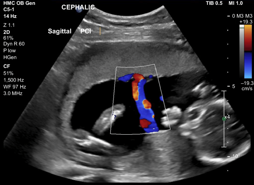 Fetal Color Doppler